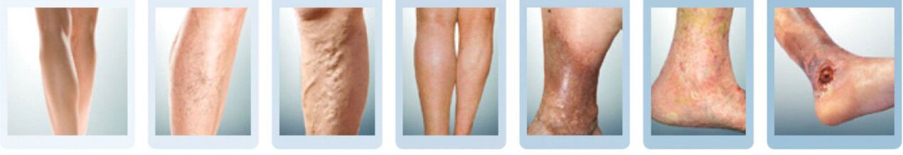 a lábak varikózisának fejlődési szakaszai