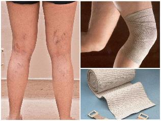 sós kötések visszér ellen tinktúra a varikózisos lábak számára
