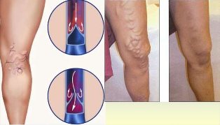 A varikózis okai, tünetei és kezelése férfiaknál a lábakon - Fekélyek 