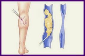 A szkleroterápia egy népszerű módszer a lábak visszéreinek megszabadulására