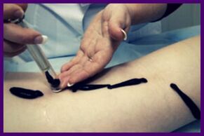 Eljárás a varikózus vénák piócákkal való kezelésére (hirudoterápia)