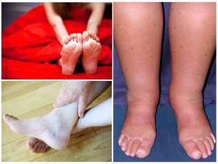 A láb visszér tüneteinek kezelése alternatív módszerrel