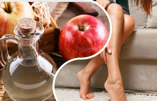 Hogyan kell használni almaecet visszeres a lába? - Recept almaecettel a visszér ellen