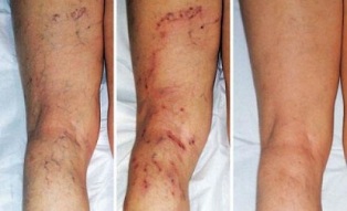 a varikózis tünetei a lábakon