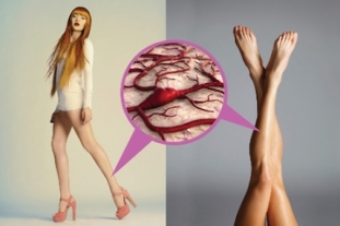Lézeres visszérműtét (EVLA) A lábak visszértágulata műtét előtt és után