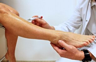 A láb belső visszér kezelése népi gyógymódokkal
