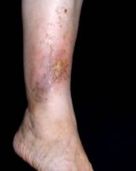 Piros foltok a visszeres lábakon: okok, tünetek és kezelés - Bonyodalmak 