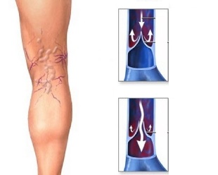 visszér az első szakasz thrombophlebitis visszerek a lábakon kezelés